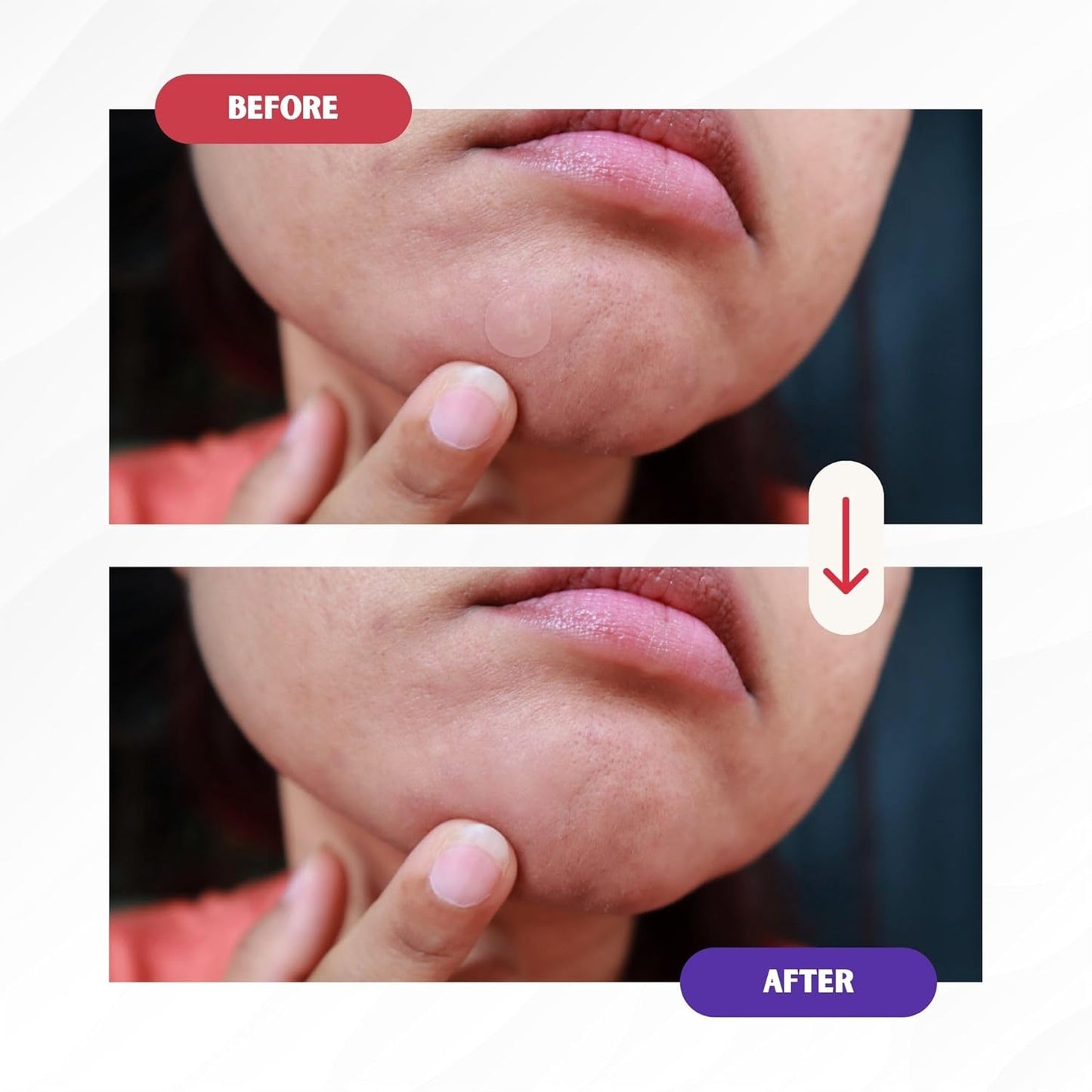Pimple Patches: Pimple Patches for Face - Acne Patches for Face - Pimple Patch - Acne Patches - Pimple Patched Stars - Pimple Patches Cute - Star Pimple Patches for Face(104 Patches/ 2 Shapes)
