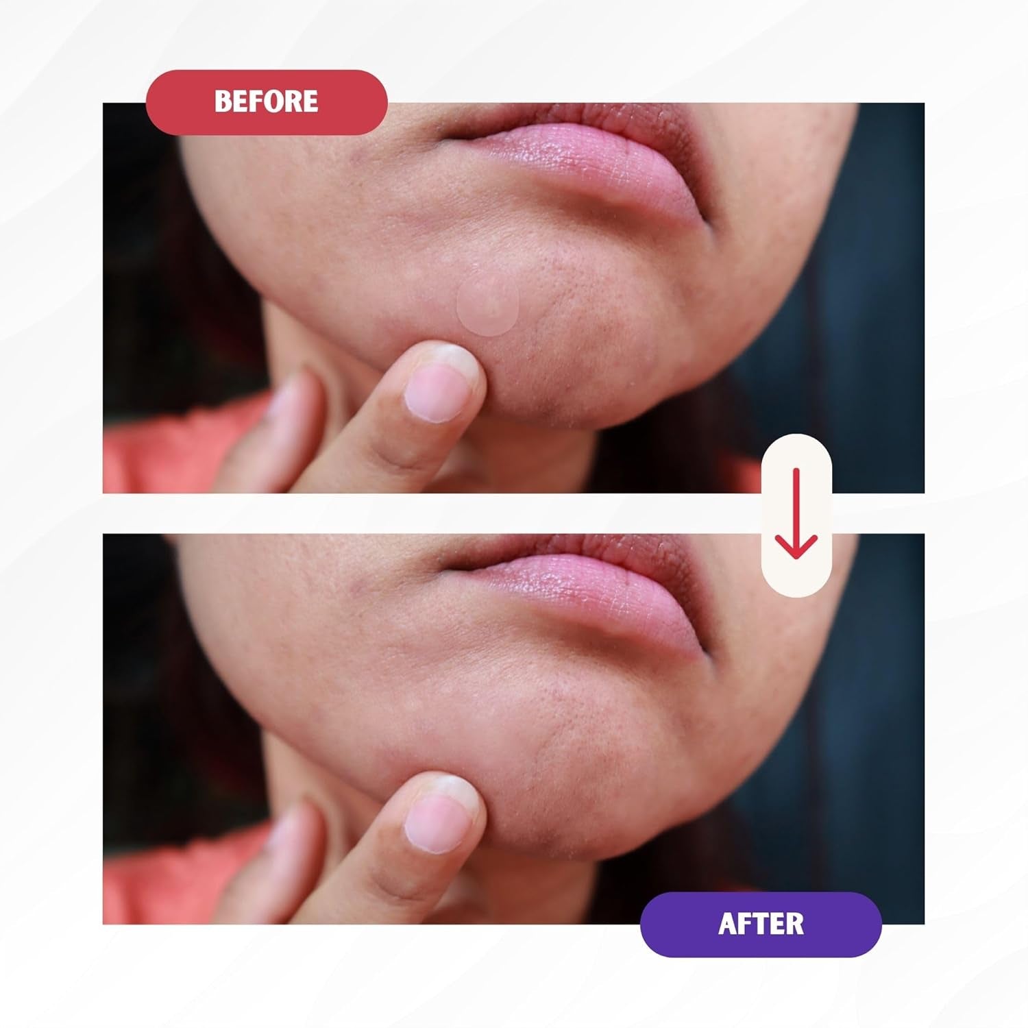 Pimple Patches: Pimple Patches for Face - Acne Patches for Face - Pimple Patch - Acne Patches - Pimple Patched Stars - Pimple Patches Cute - Star Pimple Patches for Face(104 Patches/ 2 Shapes)